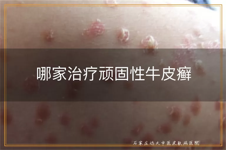 哪家治疗顽固性牛皮癣