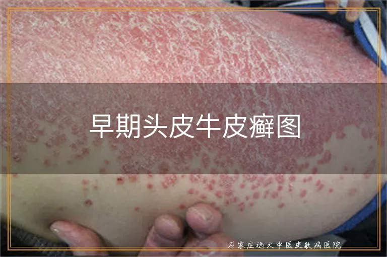 早期头皮牛皮癣图