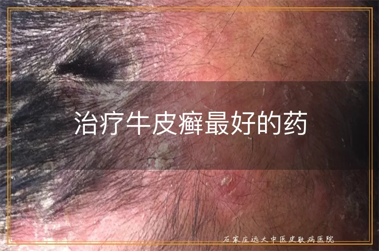 治疗牛皮癣最好的药