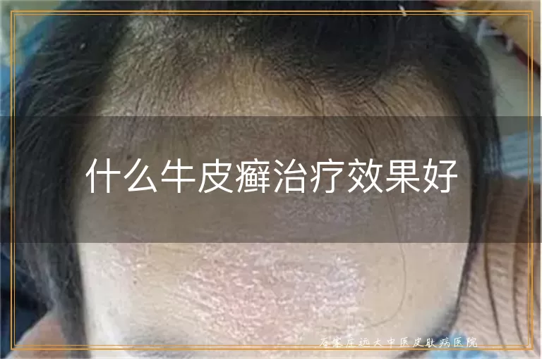什么牛皮癣治疗效果好