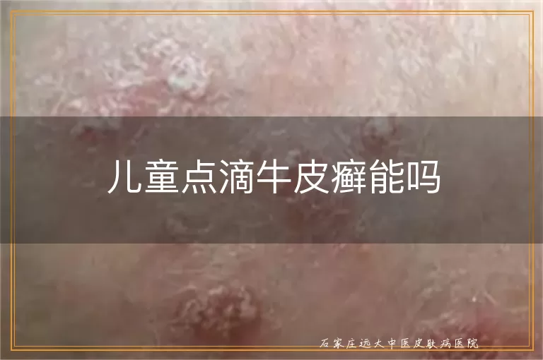 儿童点滴牛皮癣能吗