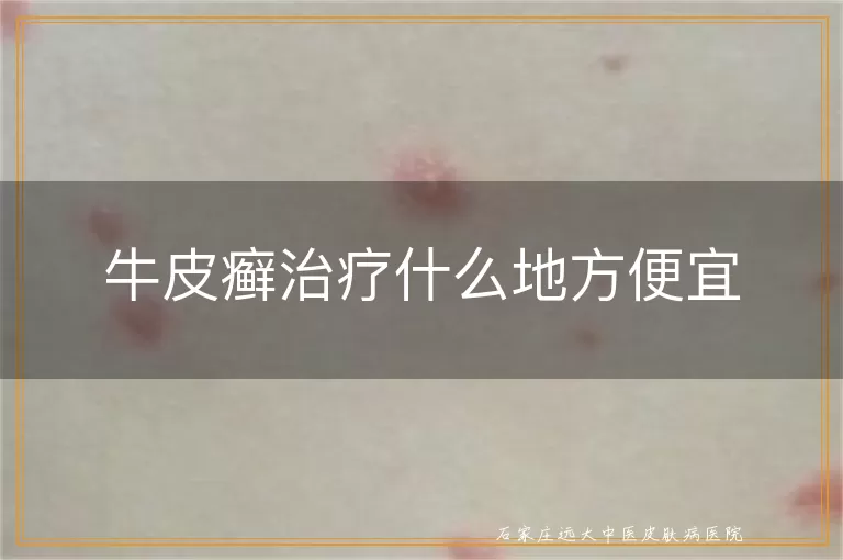牛皮癣治疗什么地方便宜
