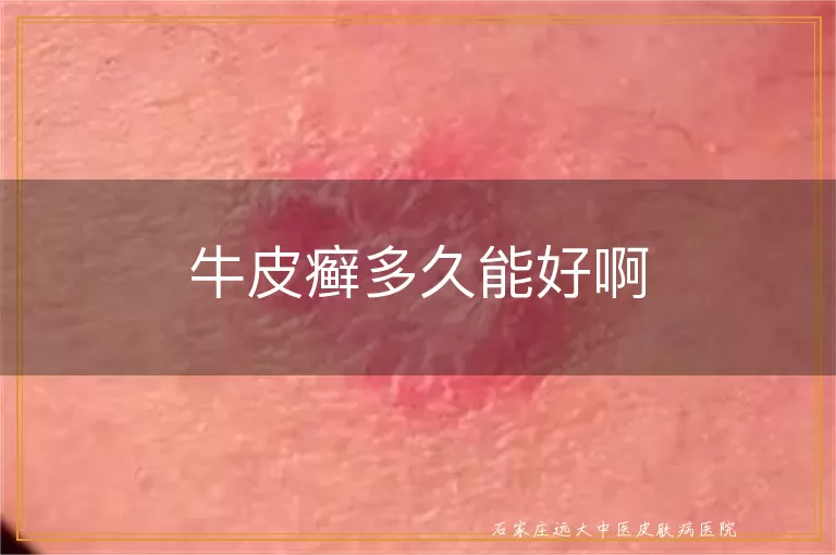 牛皮癣多久能好啊