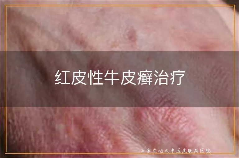 红皮性牛皮癣治疗