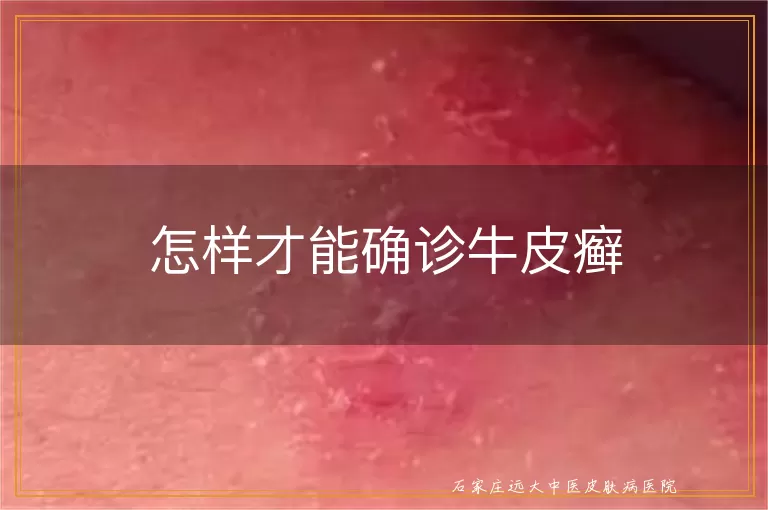 怎样才能确诊牛皮癣