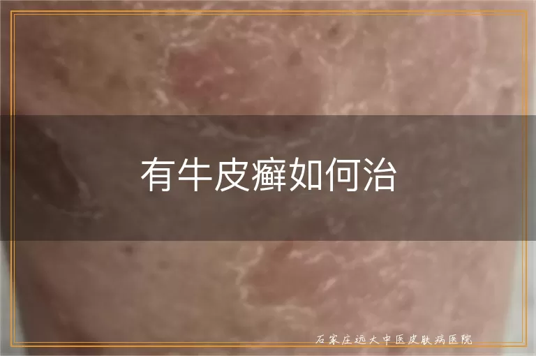 有牛皮癣如何治