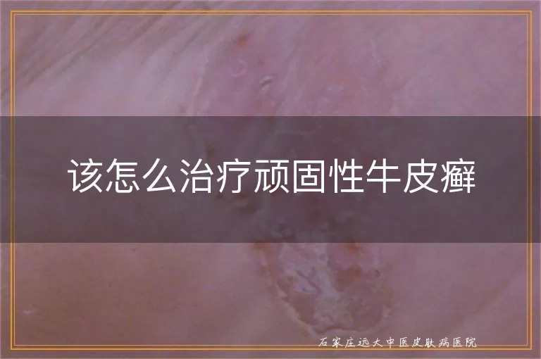 该怎么治疗顽固性牛皮癣