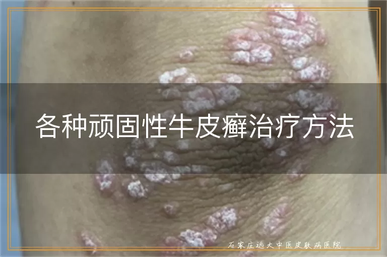各种顽固性牛皮癣治疗方法