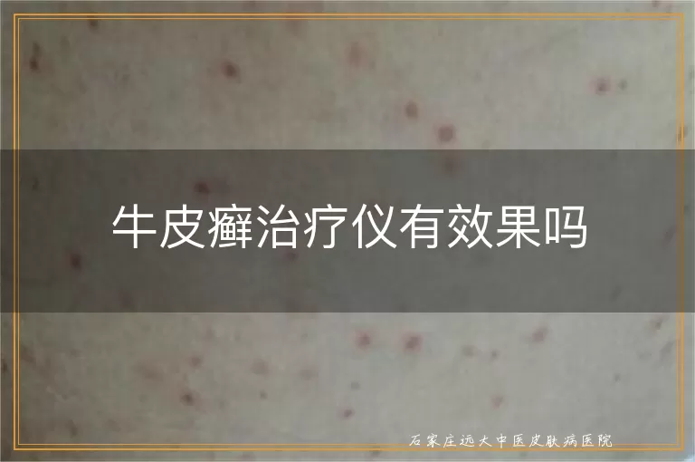 牛皮癣治疗仪有效果吗