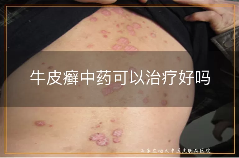 牛皮癣中药可以治疗好吗
