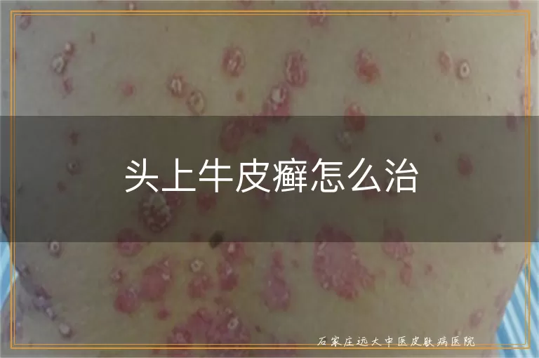 头上牛皮癣怎么治