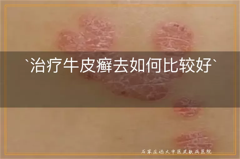 治疗牛皮癣去如何比较好