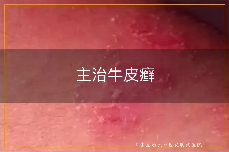 主治牛皮癣