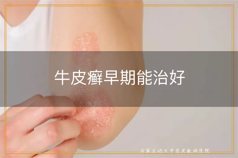 牛皮癣早期能治好