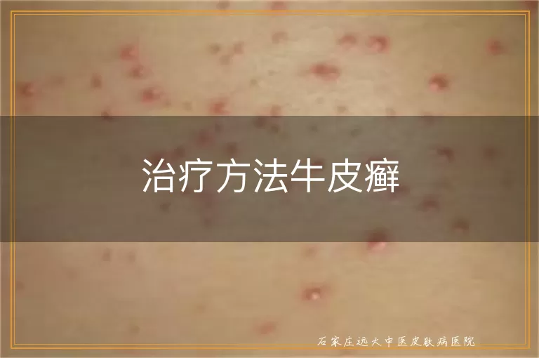 治疗方法牛皮癣