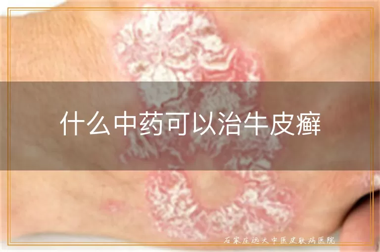 什么中药可以治牛皮癣