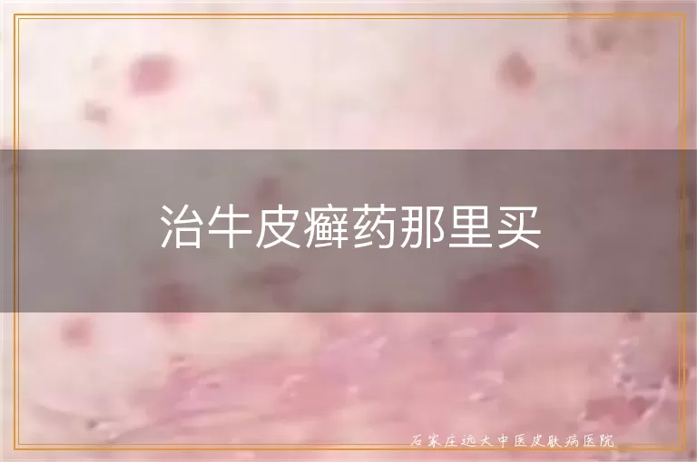 治牛皮癣药那里买