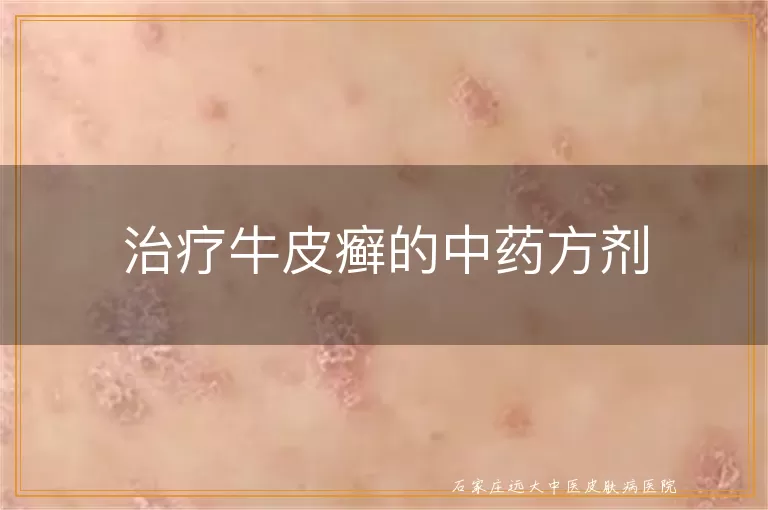 治疗牛皮癣的中药方剂