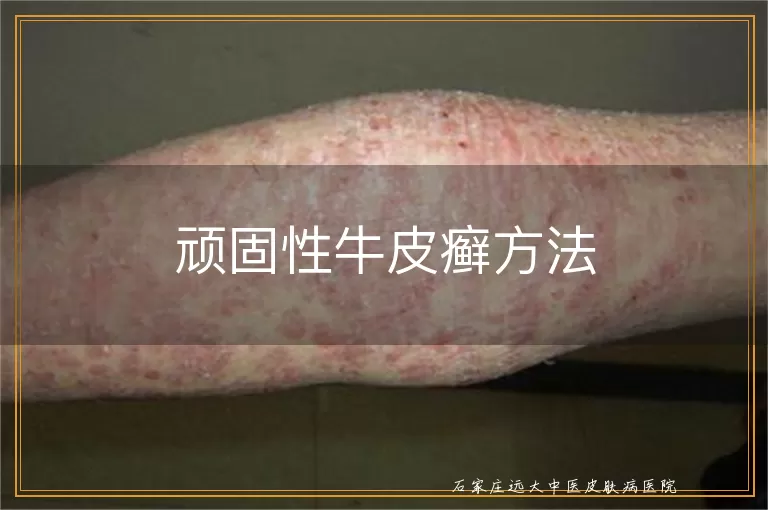 顽固性牛皮癣方法