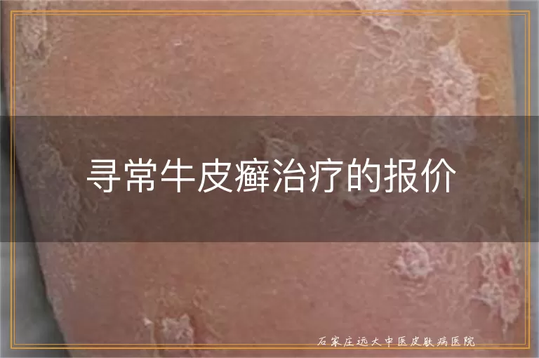 寻常牛皮癣治疗的报价
