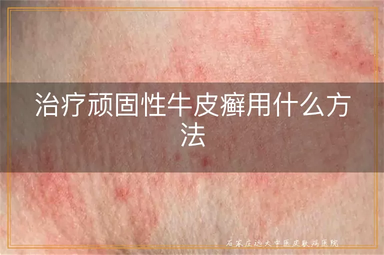 治疗顽固性牛皮癣用什么方法