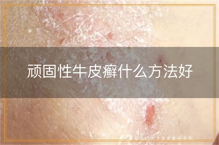 顽固性牛皮癣什么方法好