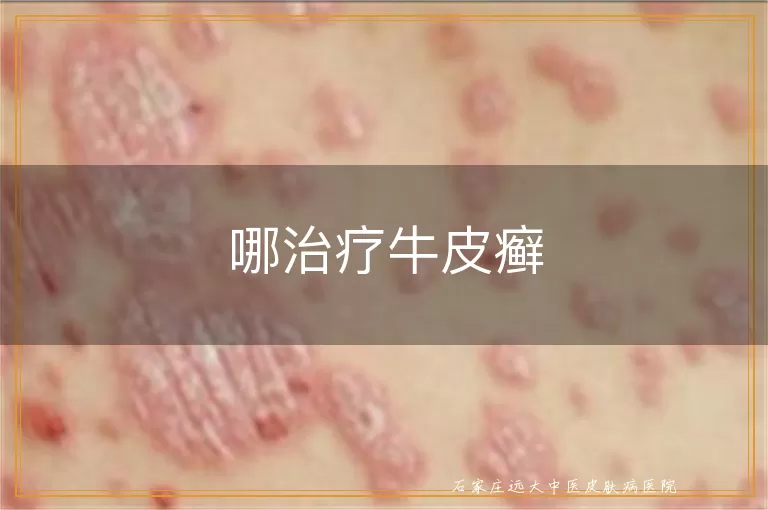 哪治疗牛皮癣
