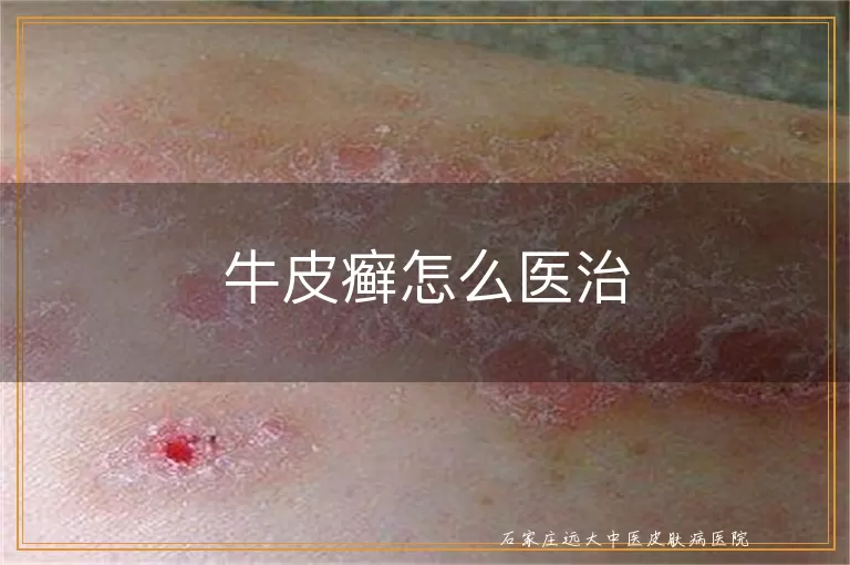 牛皮癣怎么医治