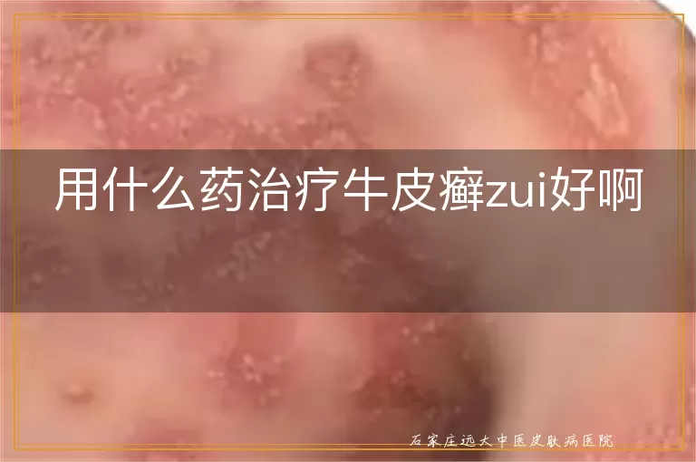 用什么药治疗牛皮癣zui好啊