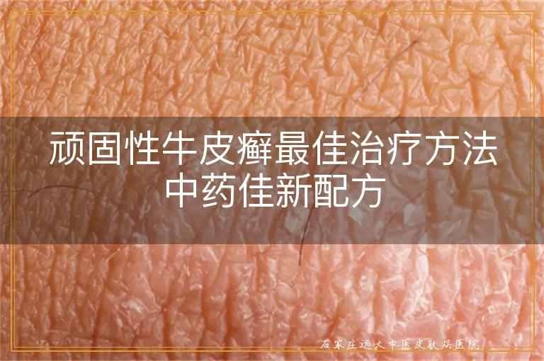 顽固性牛皮癣最佳治疗方法中药佳新配方