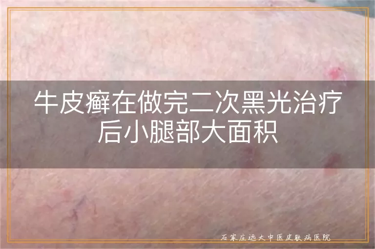 牛皮癣在做完二次黑光治疗后小腿部大面积