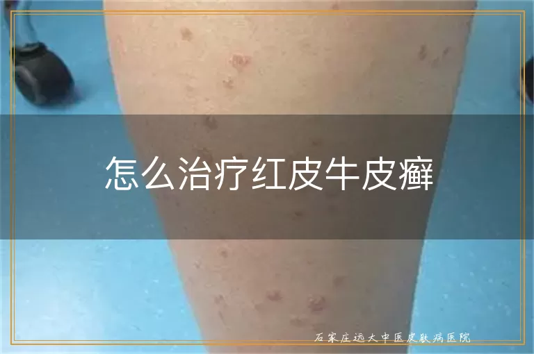 怎么治疗红皮牛皮癣