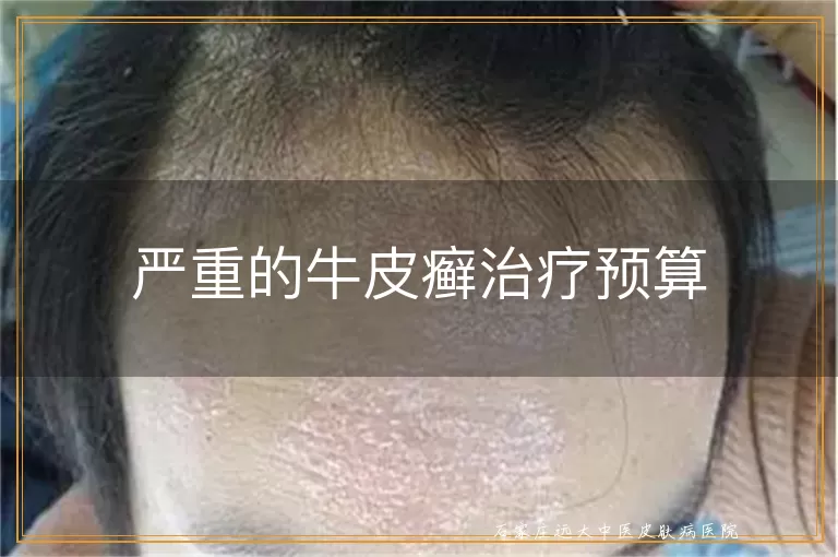 严重的牛皮癣治疗预算