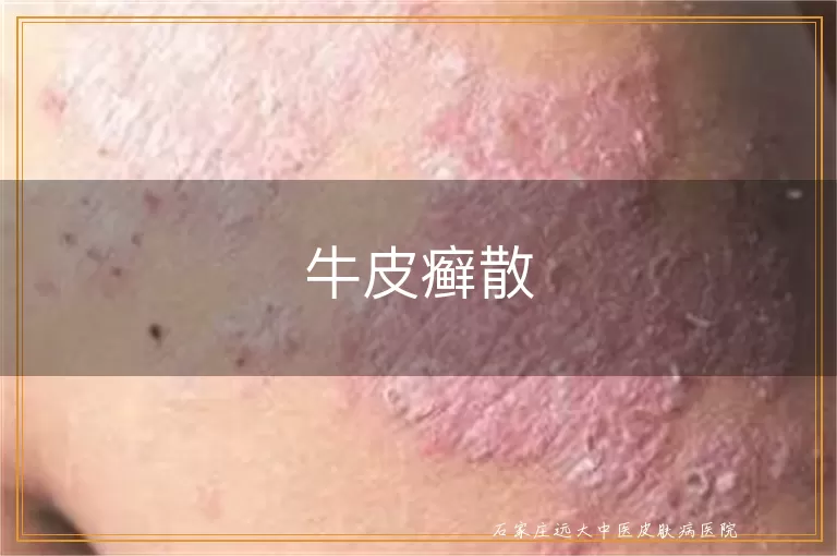 牛皮癣散