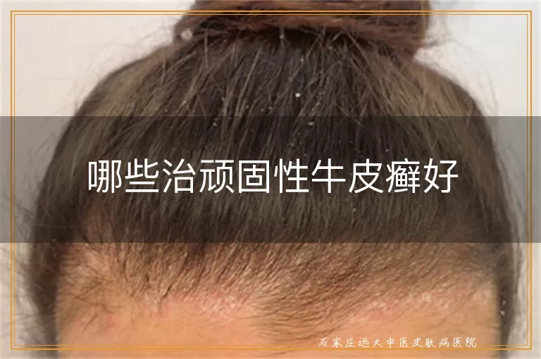哪些治顽固性牛皮癣好