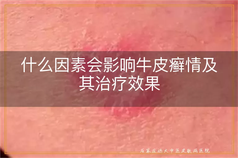 什么因素会影响牛皮癣情及其治疗效果