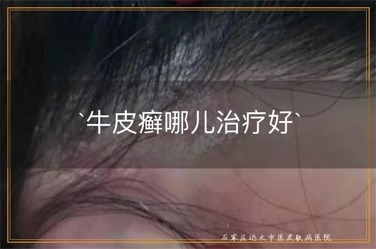 牛皮癣哪儿治疗好