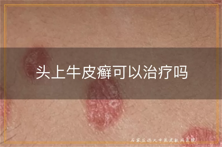 头上牛皮癣可以治疗吗