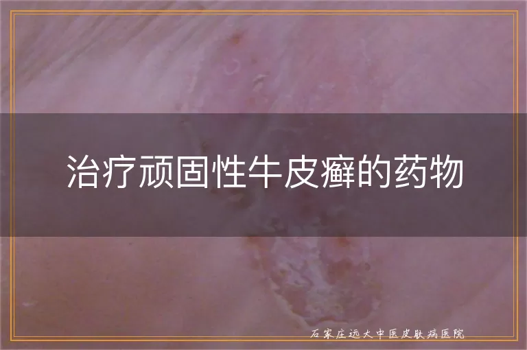 治疗顽固性牛皮癣的药物
