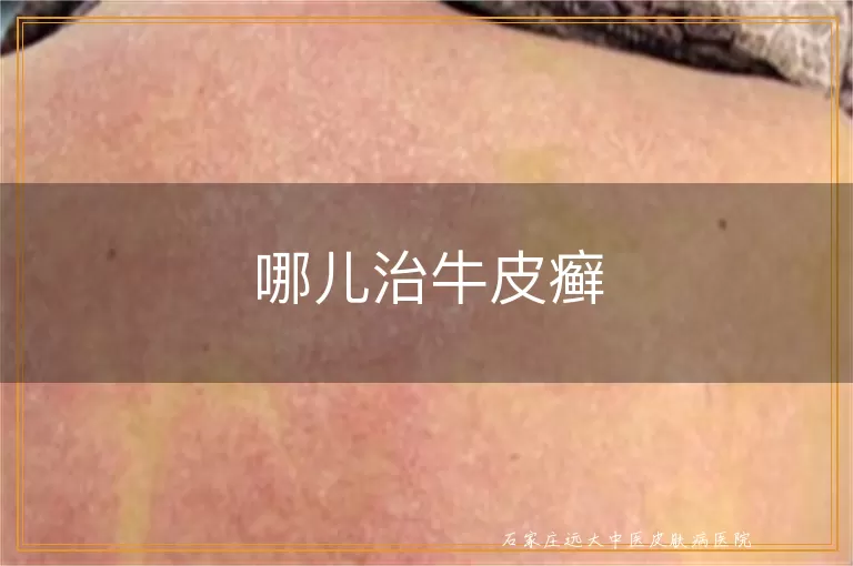 哪儿治牛皮癣