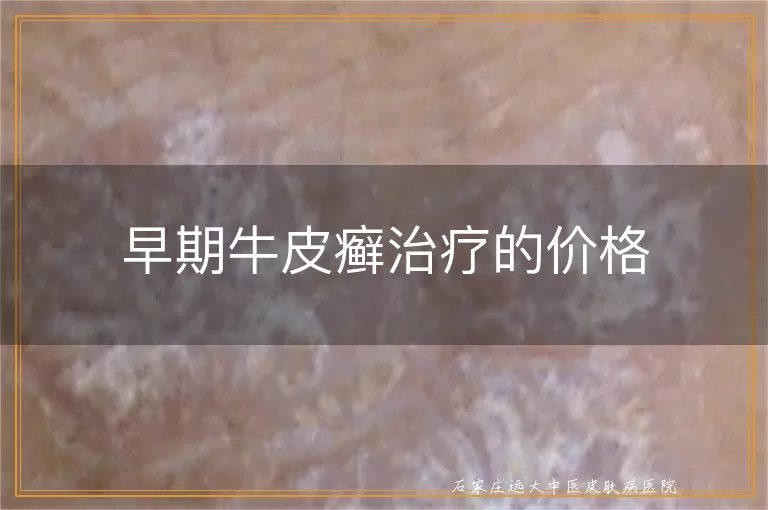 早期牛皮癣治疗的价格