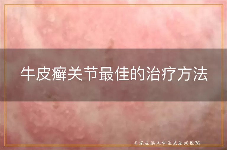 牛皮癣关节最佳的治疗方法