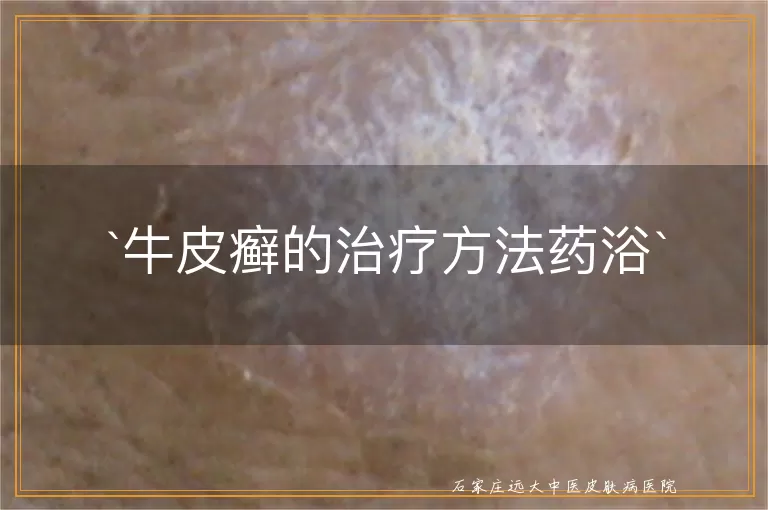 牛皮癣的治疗方法药浴