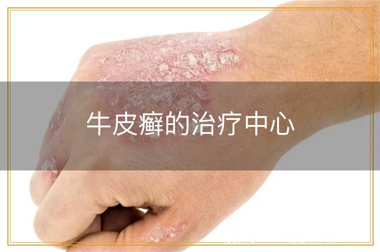 牛皮癣的治疗中心