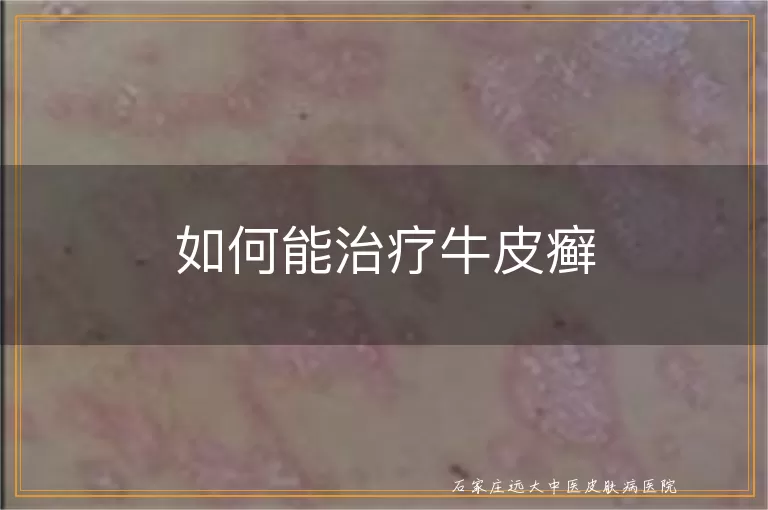 如何能治疗牛皮癣