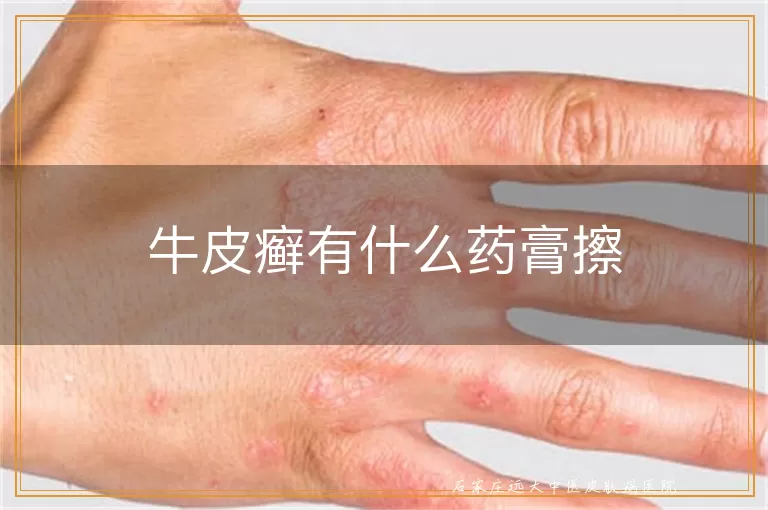牛皮癣有什么药膏擦