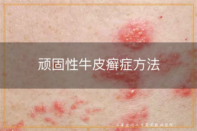 顽固性牛皮癣症方法