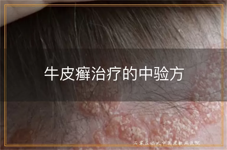 牛皮癣治疗的中验方