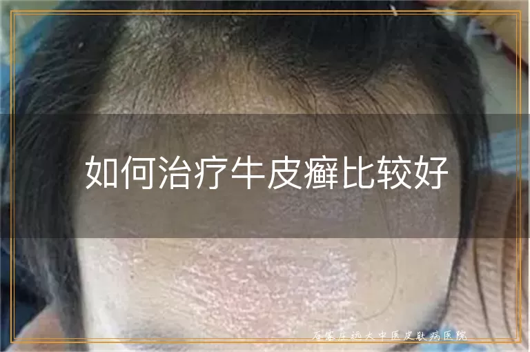 如何治疗牛皮癣比较好