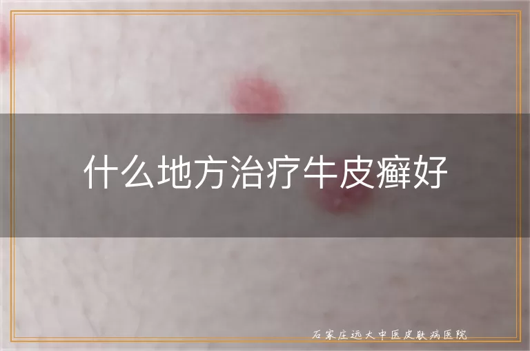 什么地方治疗牛皮癣好